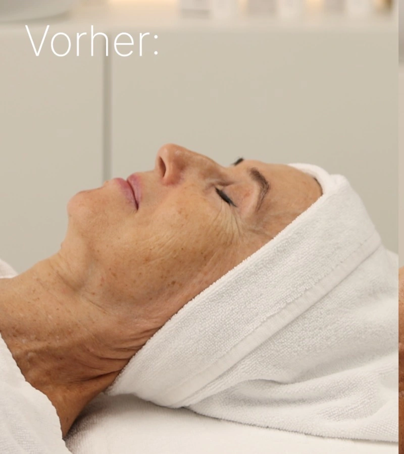 Gesichtsprofil vor der Intra-Skin-Behandlung