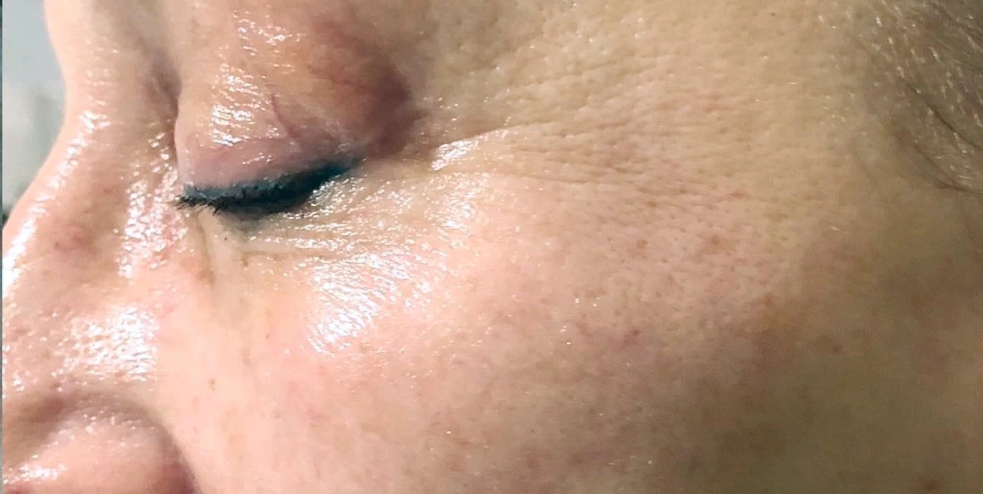 Augenpartie nach der Intra-Skin-Behandlung