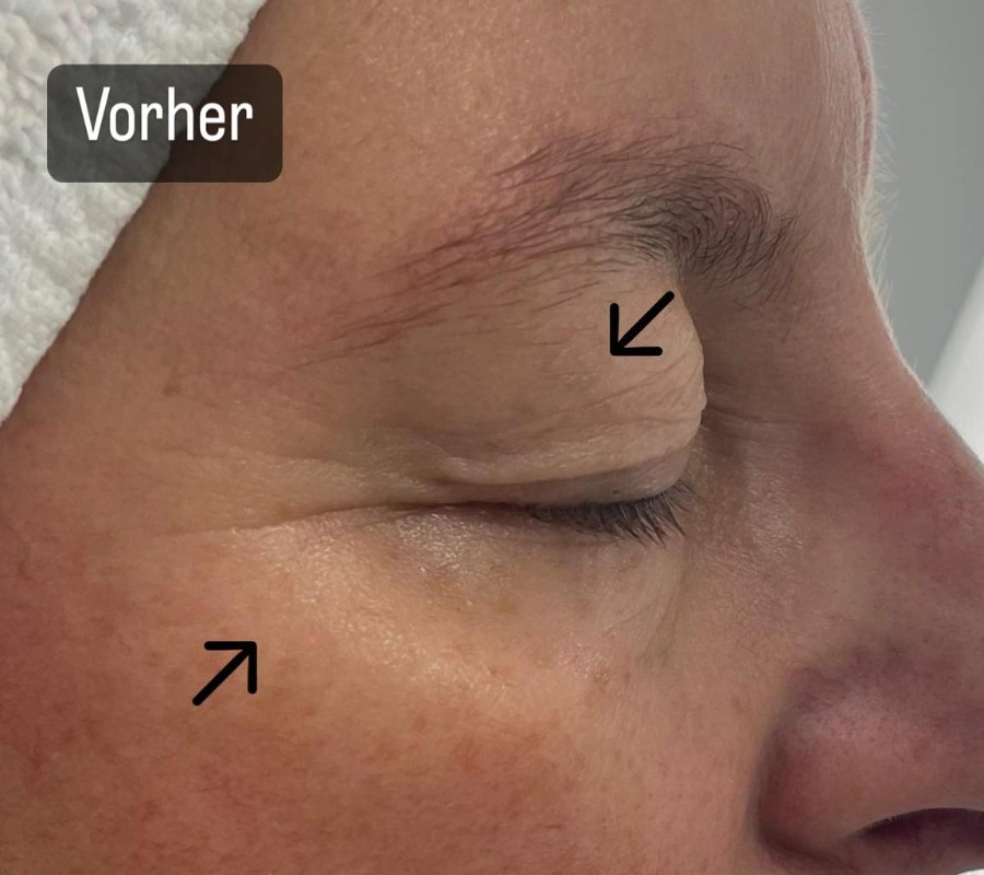 Augen- und Wangenpartie vor der Intra-Skin-Behandlung