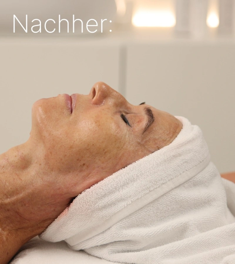 Gesichtsprofil nach der Intra-Skin-Behandlung
