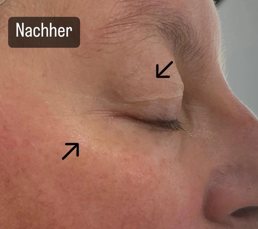 Augen- und Wangenpartie nach der Intra-Skin-Behandlung
